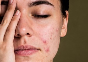  چگونه لک های صورت را درمان کنیم